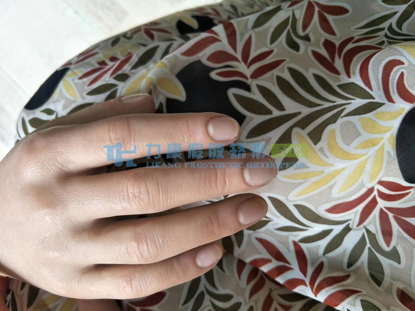 河南假肢中心咨詢電話鄭州力康假肢廠家(圖1) 河南假肢中心咨詢電話鄭州力康假肢廠家(圖1)